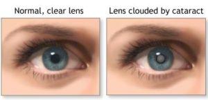 Cataract example