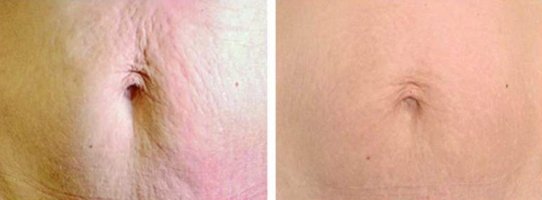 MicroNeedling before & after