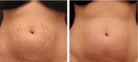 MicroNeedling before & after