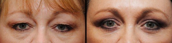 Eyelid Surgery before & after