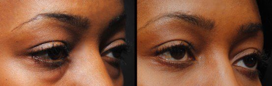 Eyelid Surgery before & after