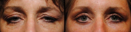 Eyelid Surgery before & after