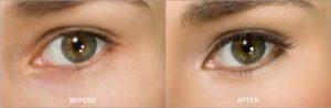 Cosmetic Eyebrow Tattooing Before & After