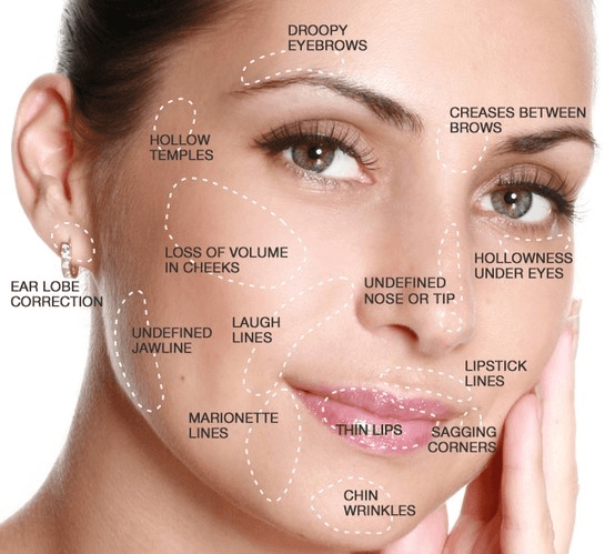 Dermal fillers diagram