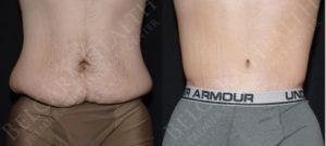 Body Contouring for men before & after