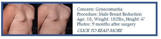 Male Breast Reduction case of the month