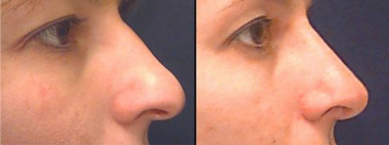 Rhinoplasty before & after