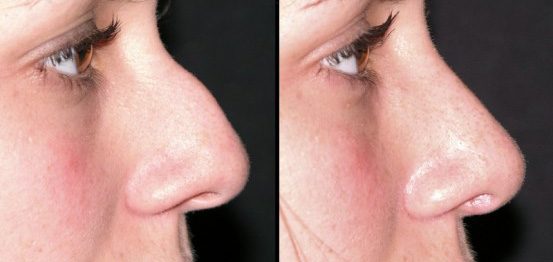 Rhinoplasty before & after