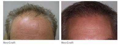 male patient before and after neograft