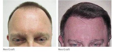 male patient before and after neograft