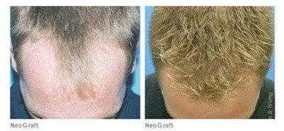male patient before and after neograft