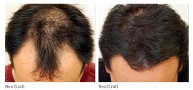 male patient before and after neograft