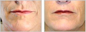 laser peel patient's lips