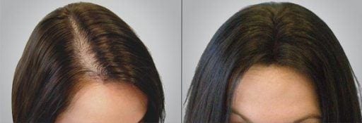 Female hair restoration patient