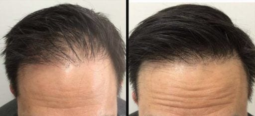 male hair restoration patient