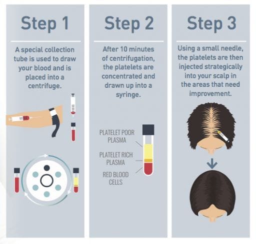 PRP step-by-step infographic