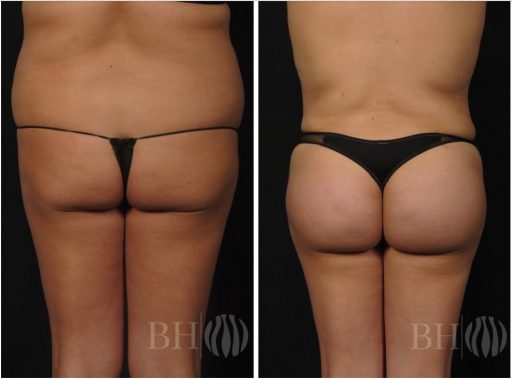 Baltimore Brazilian butt lift before and after photos