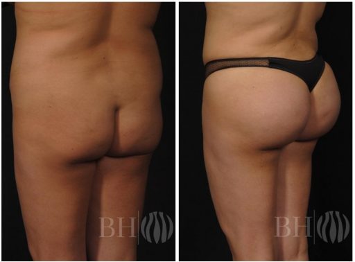 Before and after photos of Baltimore Brazilian butt lift.